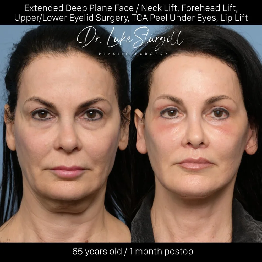 Deep plane facelift before and after — front view — female patient