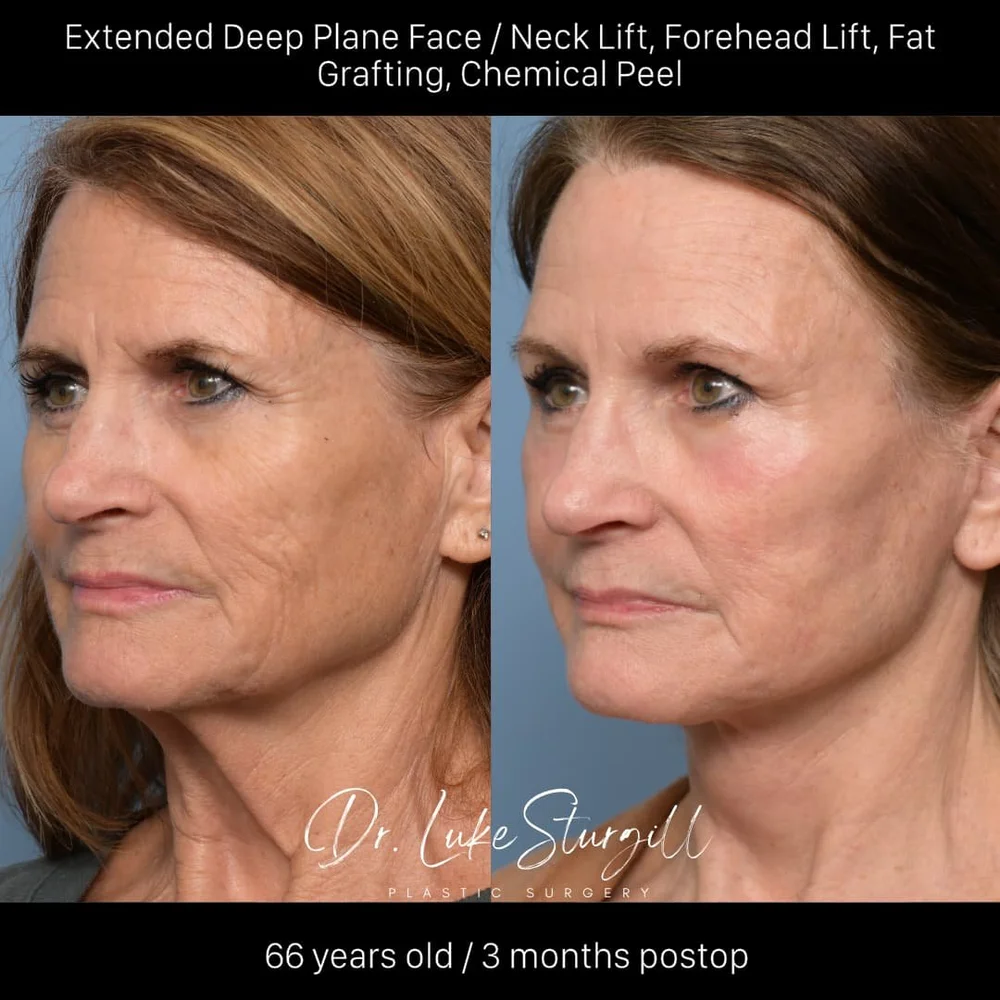 Deep plane facelift before and after — oblique view — female patient