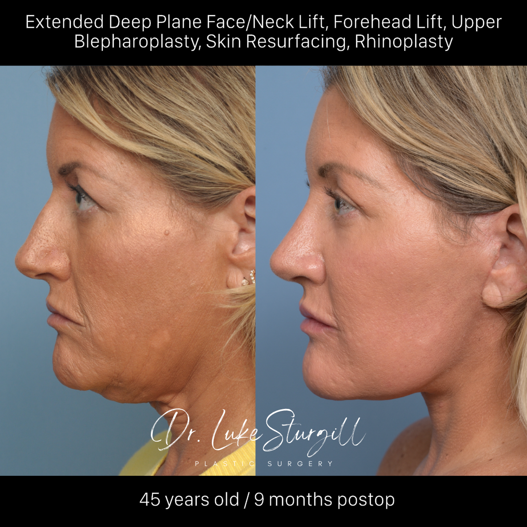 Deep plane facelift before and after — front view — female patient