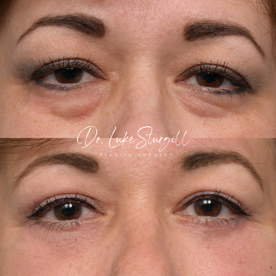 Eyelid surgery before and after — front view — female patient