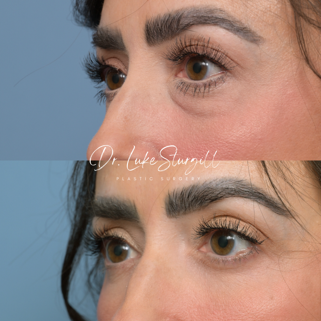 Eyelid surgery before and after — oblique view — female patient