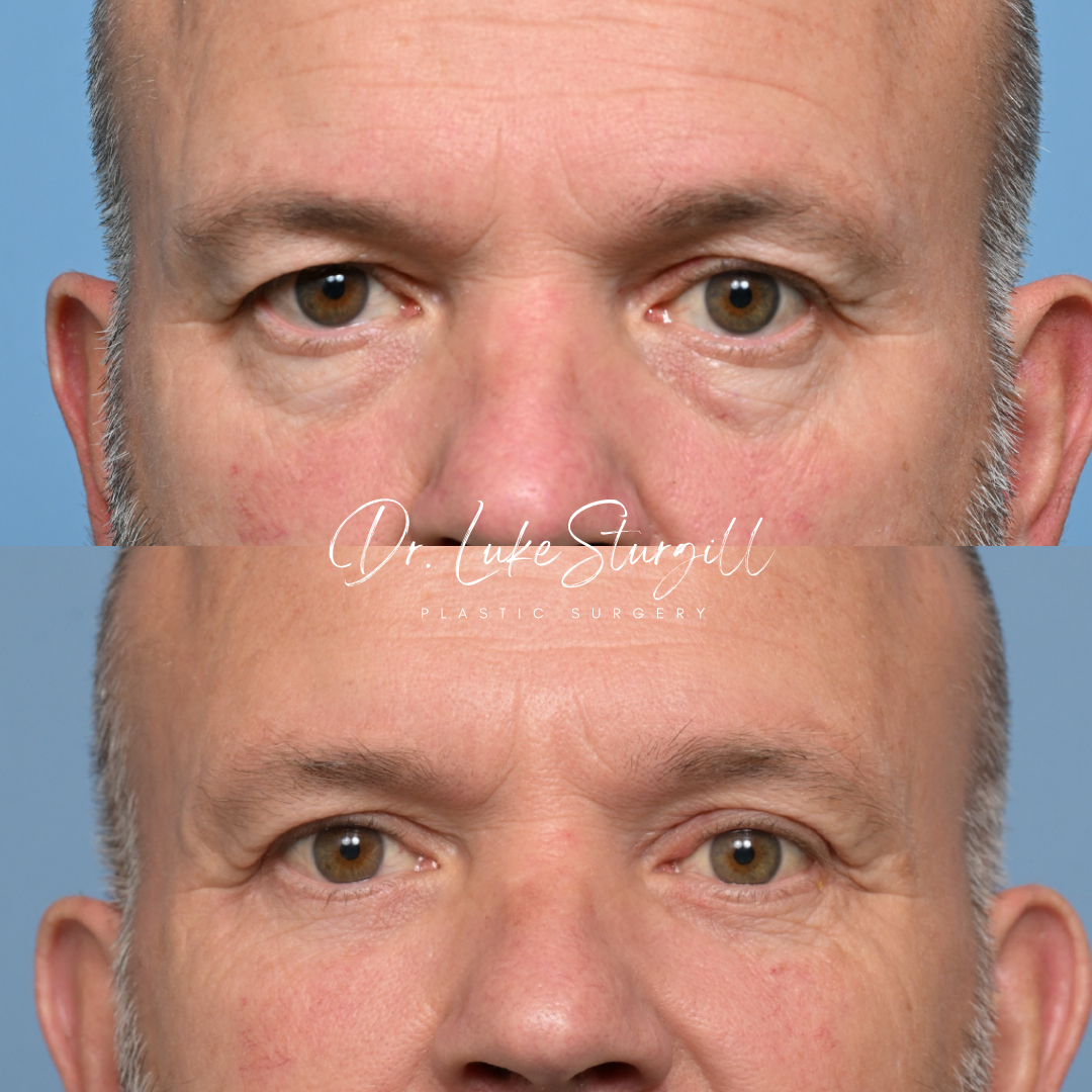 Blepharoplasty before and after — front view — female patient