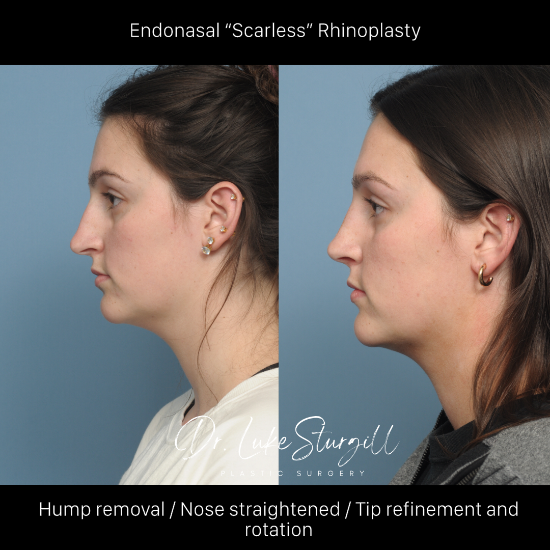Rhinoplasty before and after — front view — female patient