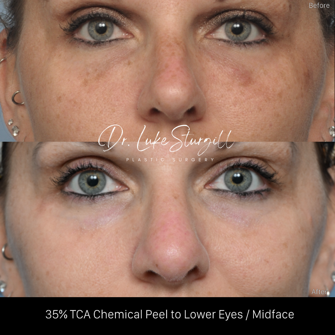 TCA 35% chemical peel before and after — midface and under eyes — female patient