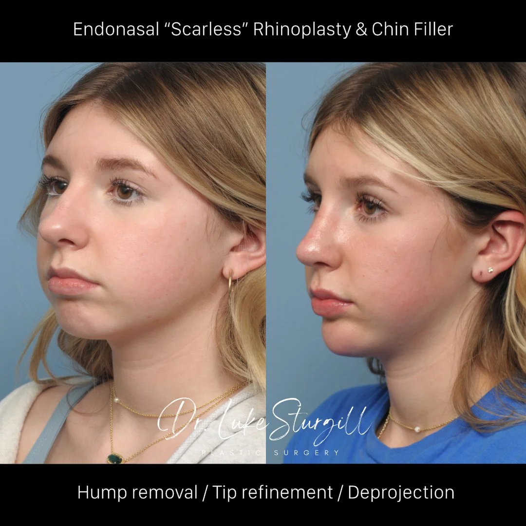 Rhinoplasty before and after — oblique view — female patient