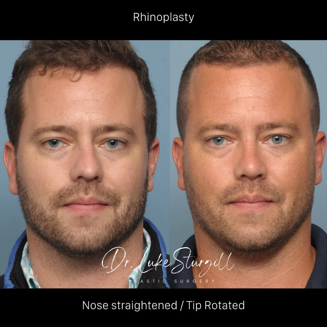 Rhinoplasty before and after — base view — female patient