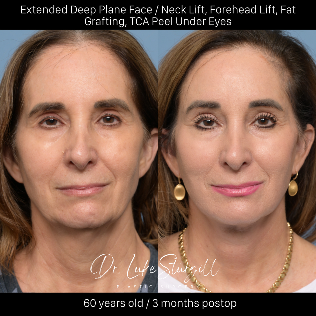Deep plane facelift before and after — oblique view — female patient