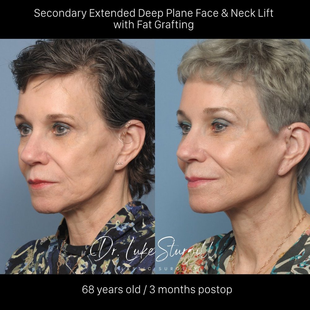 Secondary extended deep plane face and neck lift with fat grafting before and after — three months post-op
