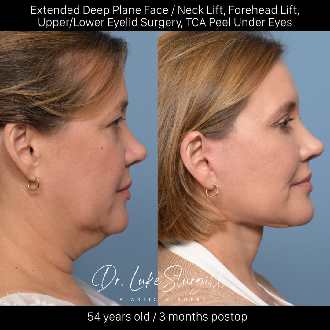 Extended Deep Plane Face and Neck Lift before and after — lateral view showing the restored cervicomental angle