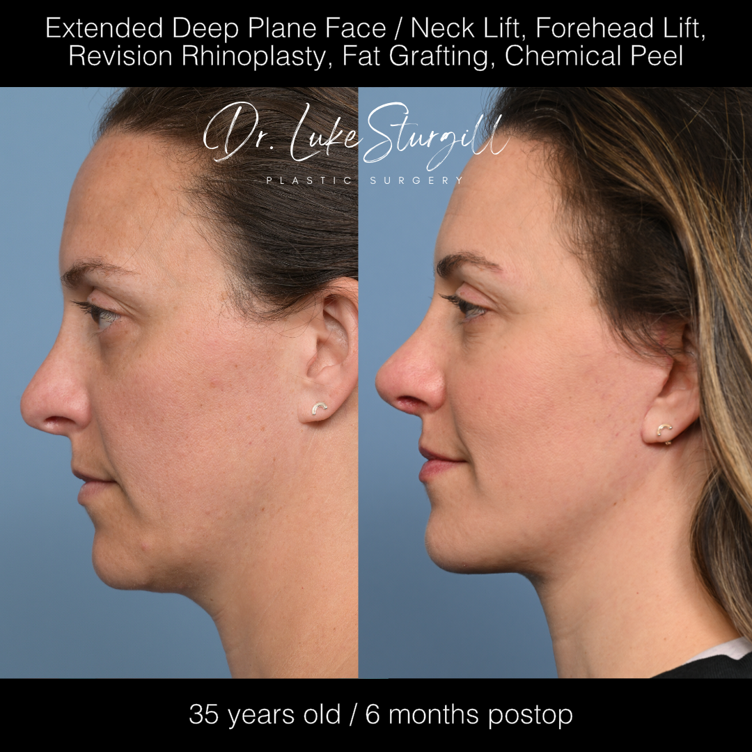 Deep plane facelift before and after — front view — female patient