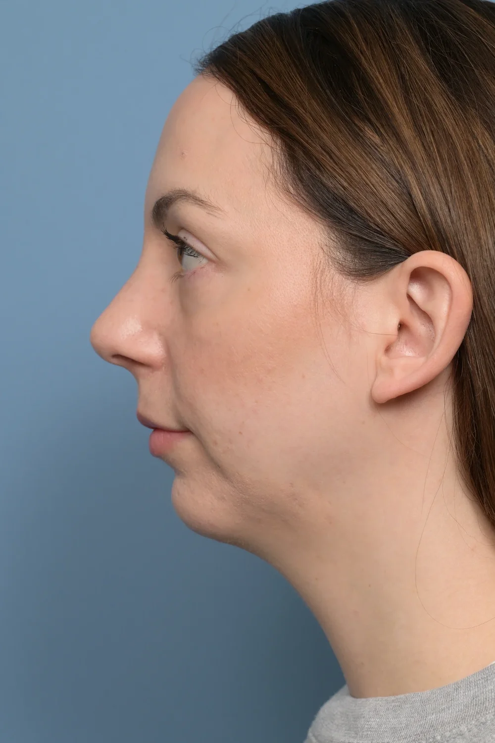 Patient profile after rhinoplasty and chin implant surgery showing improved facial balance
