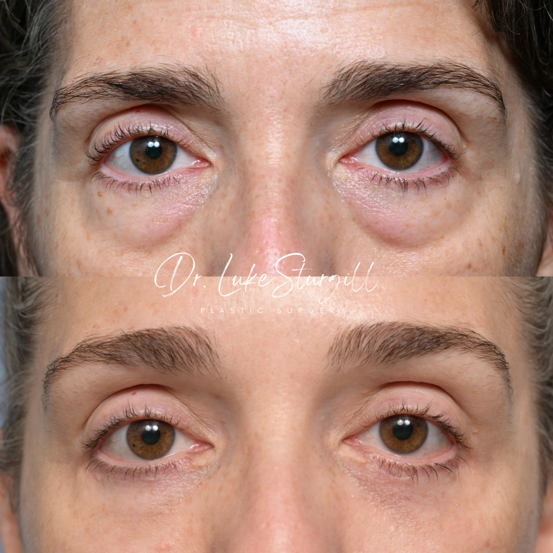 Eyelid surgery before and after — front view — female patient
