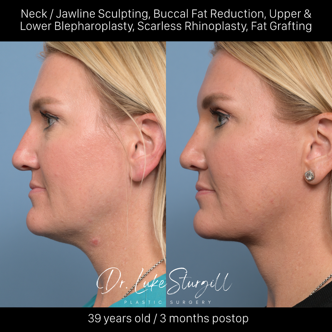 Jawline contouring before and after — front view — male patient