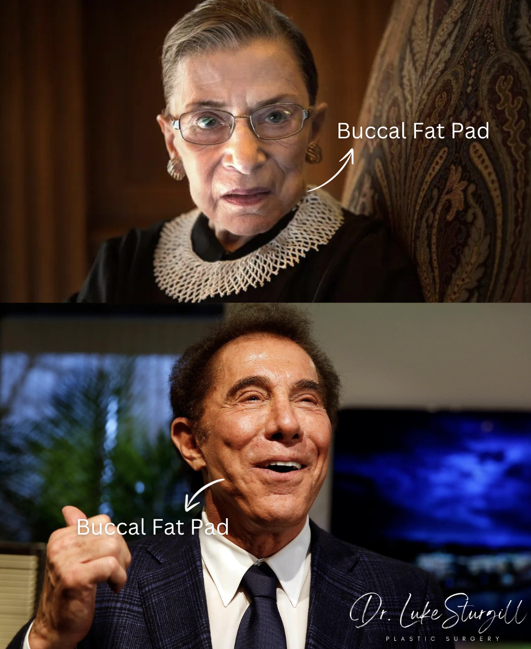 Buccal fat pad visibility in public figures — Ruth Bader Ginsburg and Steve Wynn