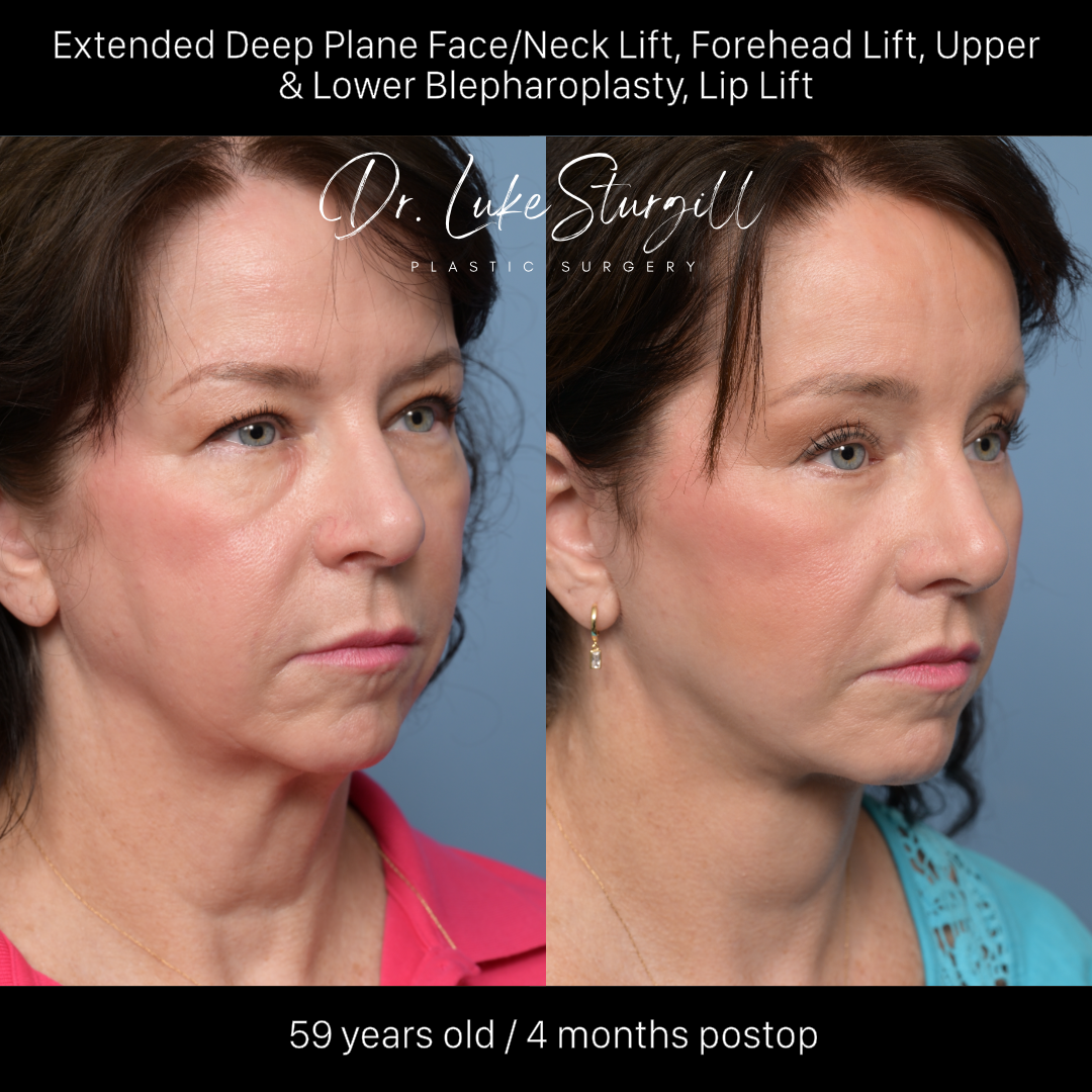 Deep plane facelift before and after — front view — female patient