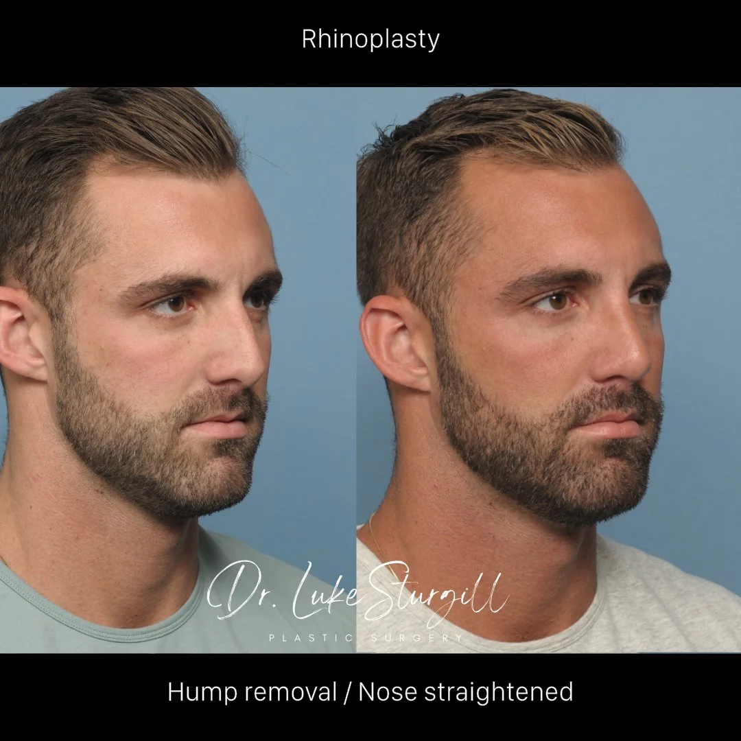 Rhinoplasty before and after — base view — male patient