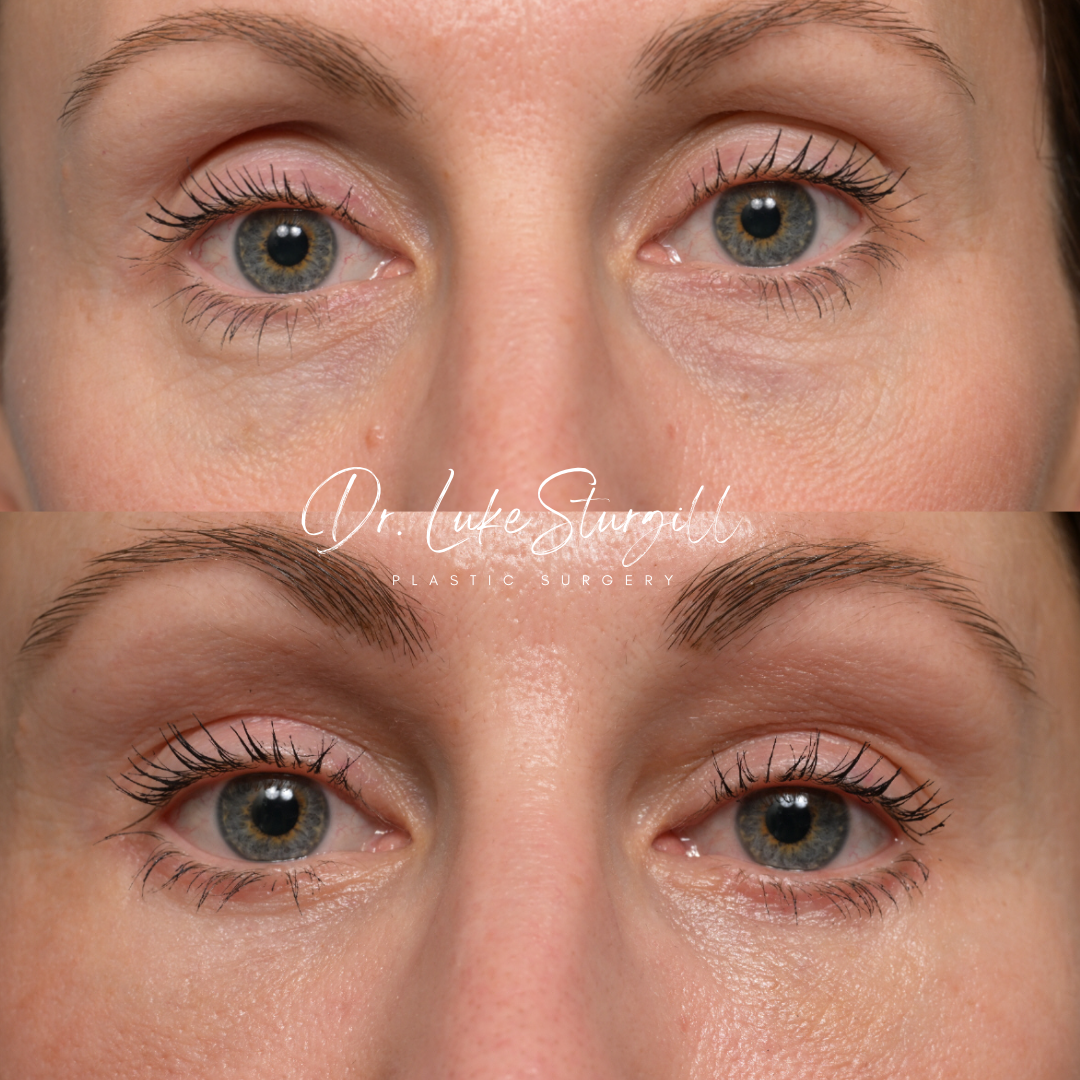 Brow lift and eyelid surgery before and after — front view — female patient
