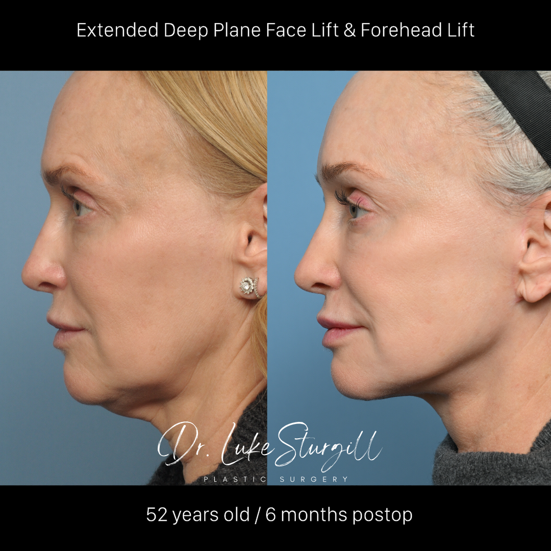 Deep plane facelift before and after — oblique view — female patient