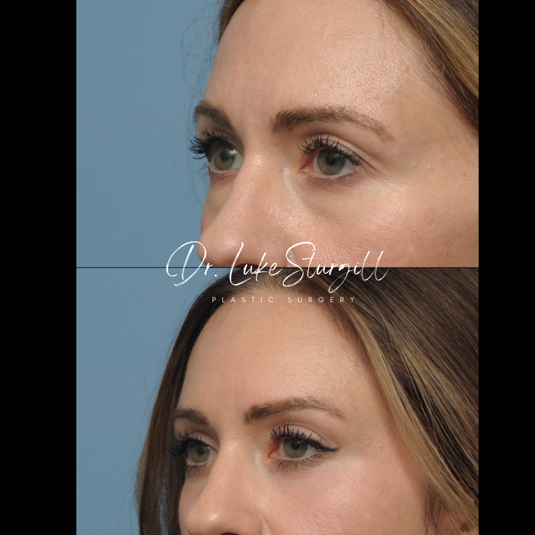 Eyelid surgery before and after — close-up — female patient