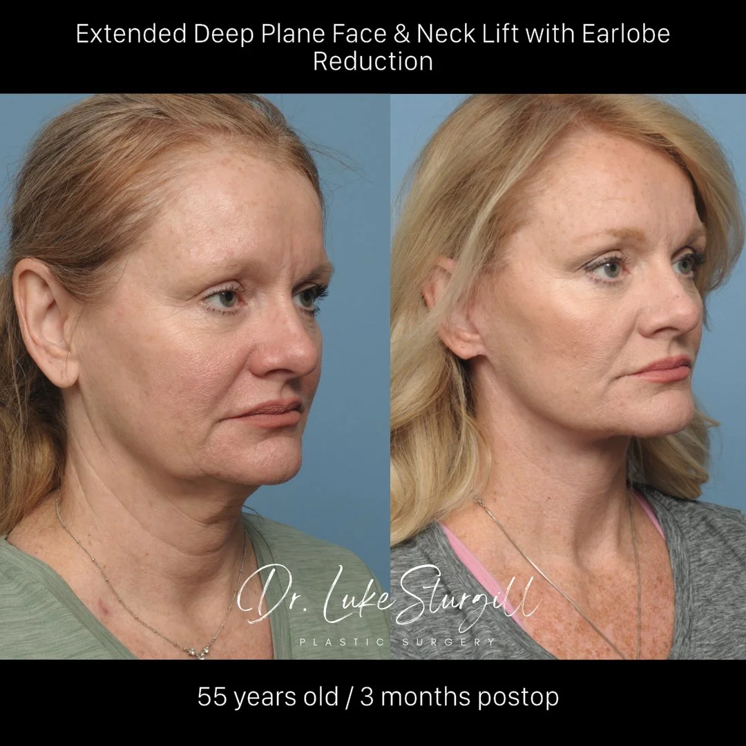 Deep plane facelift before and after — oblique view — female patient