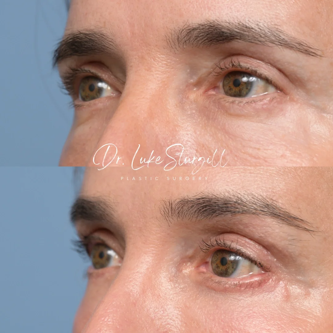 Close-up of a woman's eye area before and after cosmetic surgery, showing improved skin texture and eyelid appearance.