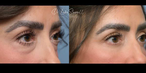 Blepharoplasty Result