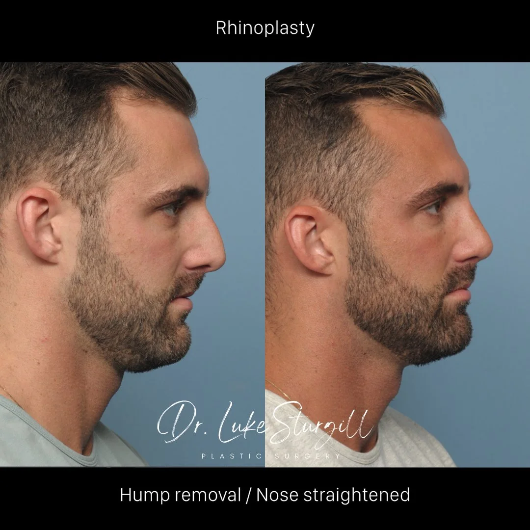 Rhinoplasty before and after — oblique view — male patient