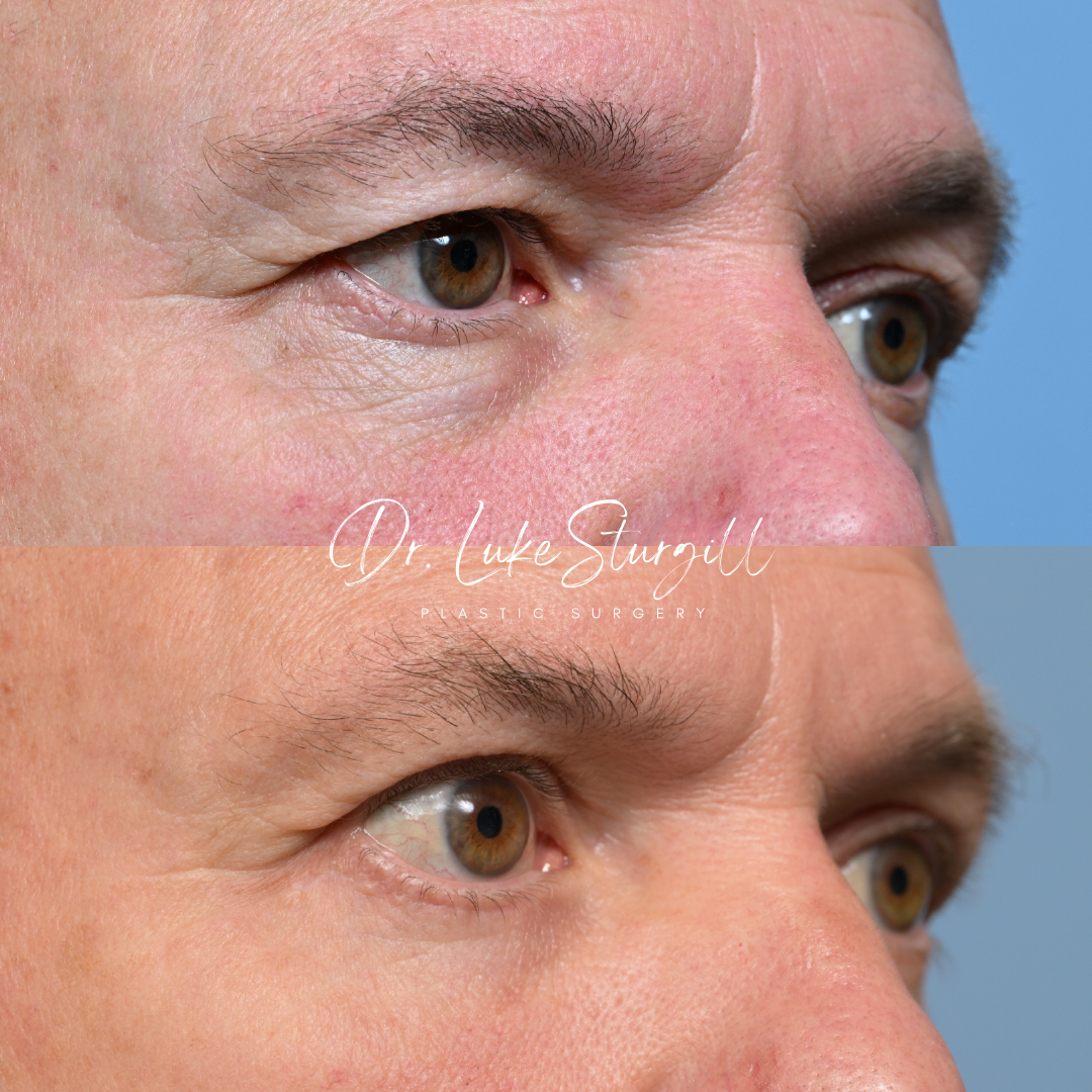 Blepharoplasty before and after — oblique view — female patient