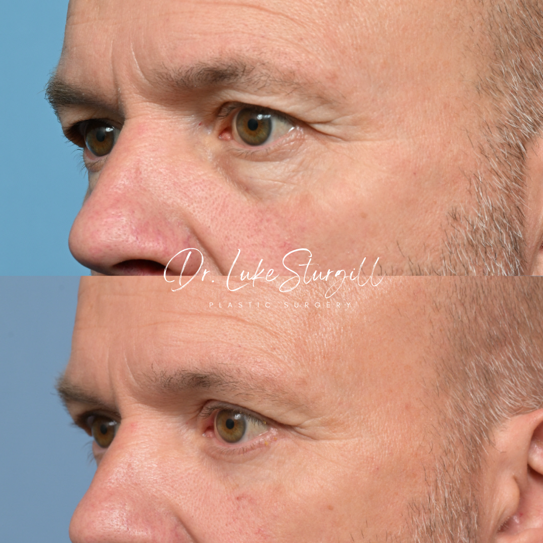 Blepharoplasty before and after — lateral view — female patient