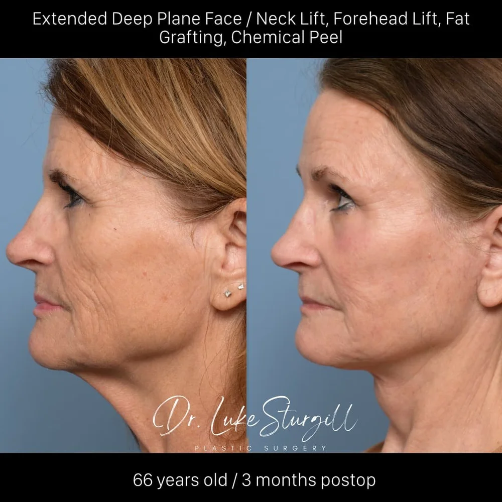 Deep plane facelift before and after — lateral view — female patient