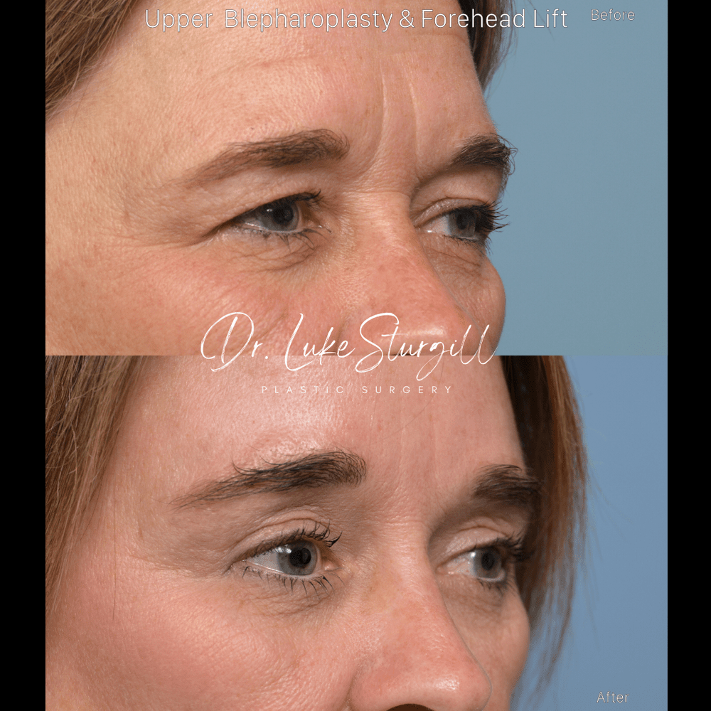 Before and after upper blepharoplasty and endoscopic brow lift by Dr. R. Luke Sturgill