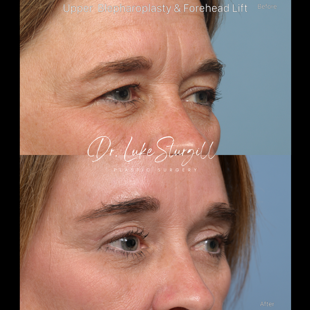 Eyelid surgery before and after — front view — female patient