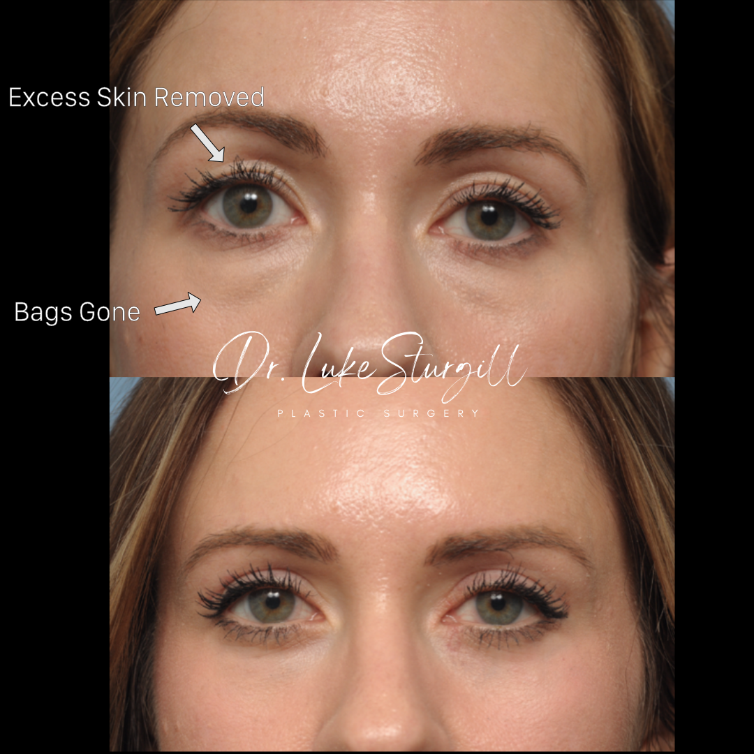 Eyelid surgery before and after — oblique view — female patient