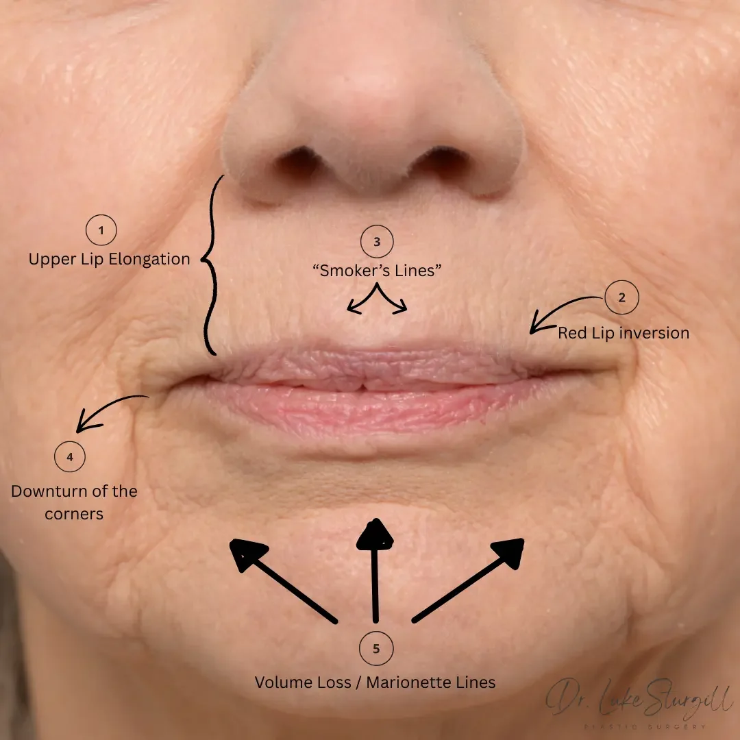 Annotated illustration showing the five key perioral aging changes: upper lip lengthening, vermilion thinning, downturned corners, perioral lines, and volume loss