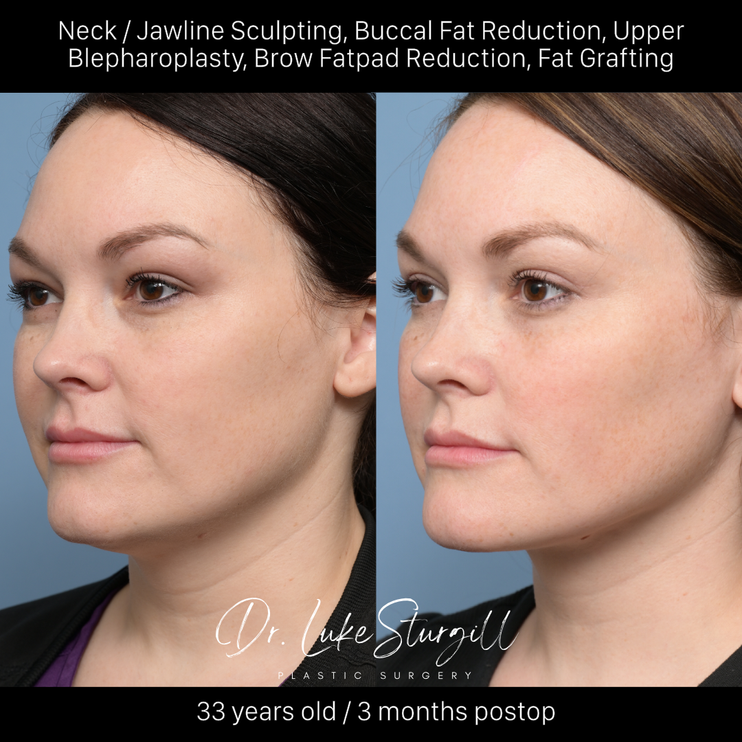 Neck and jawline sculpting before and after — oblique view — female patient