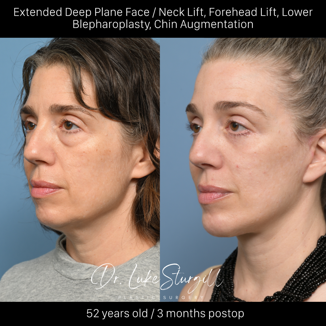Deep plane facelift before and after — oblique view — female patient
