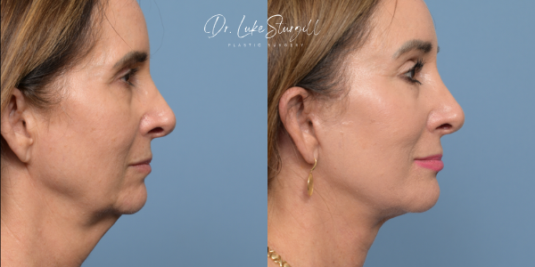 Extended Deep Plane Facelift Result