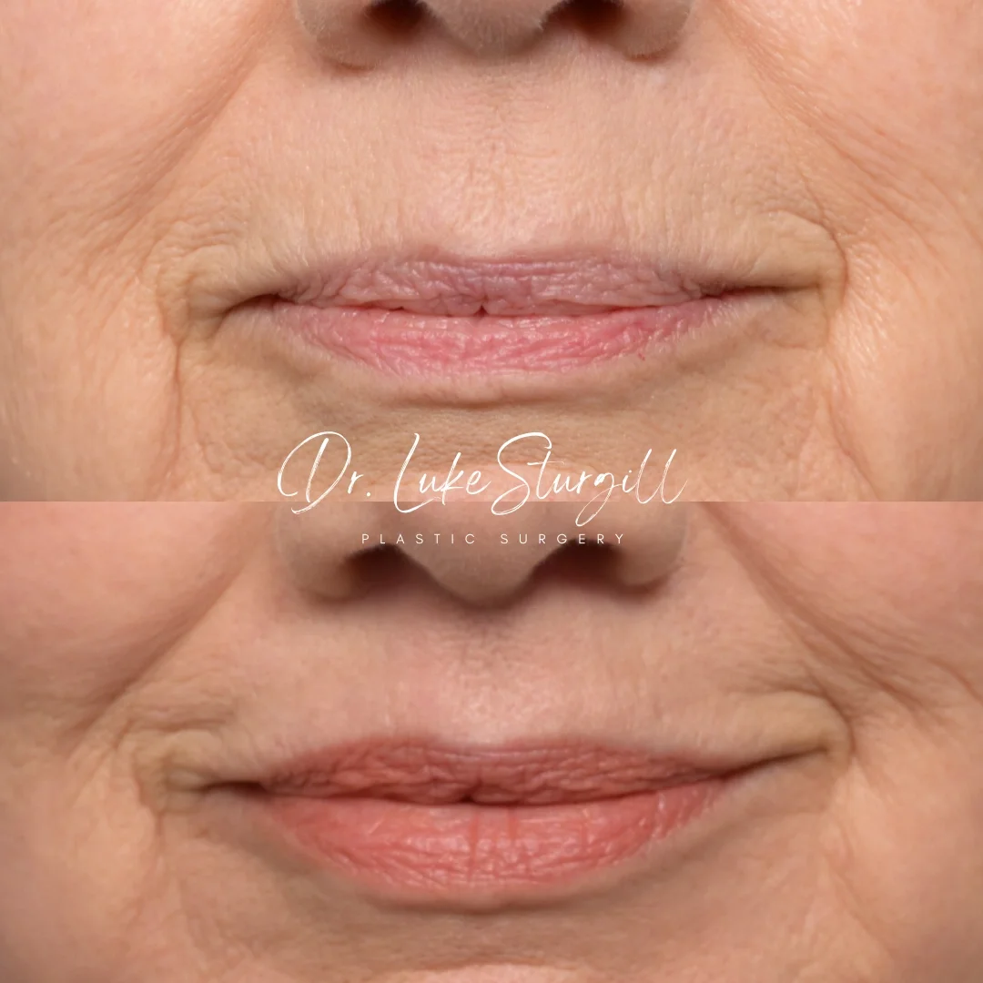 Lip lift before and after — front view — female patient