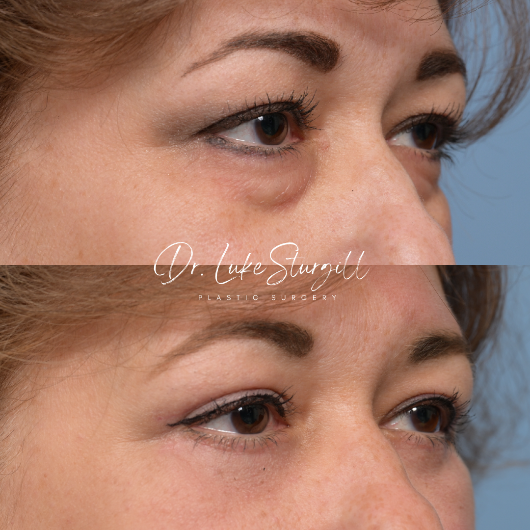 Eyelid surgery before and after — oblique view — female patient