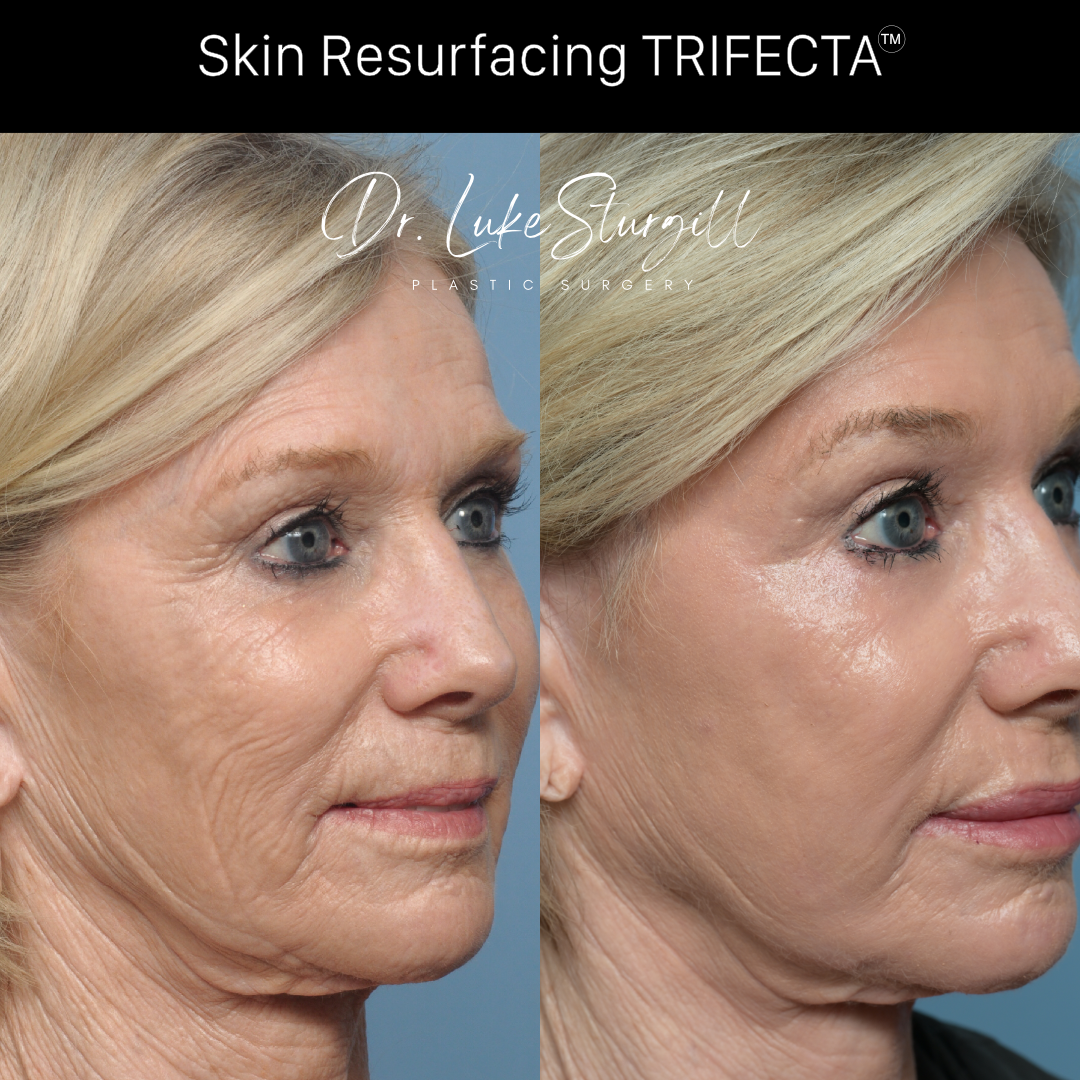Skin resurfacing Trifecta before and after — full face — female patient