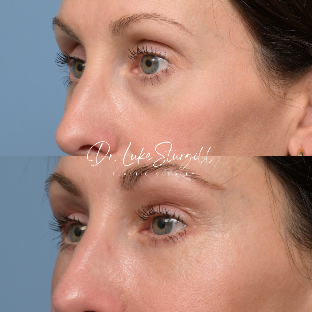 Brow lift and eyelid surgery before and after — lateral view — female patient