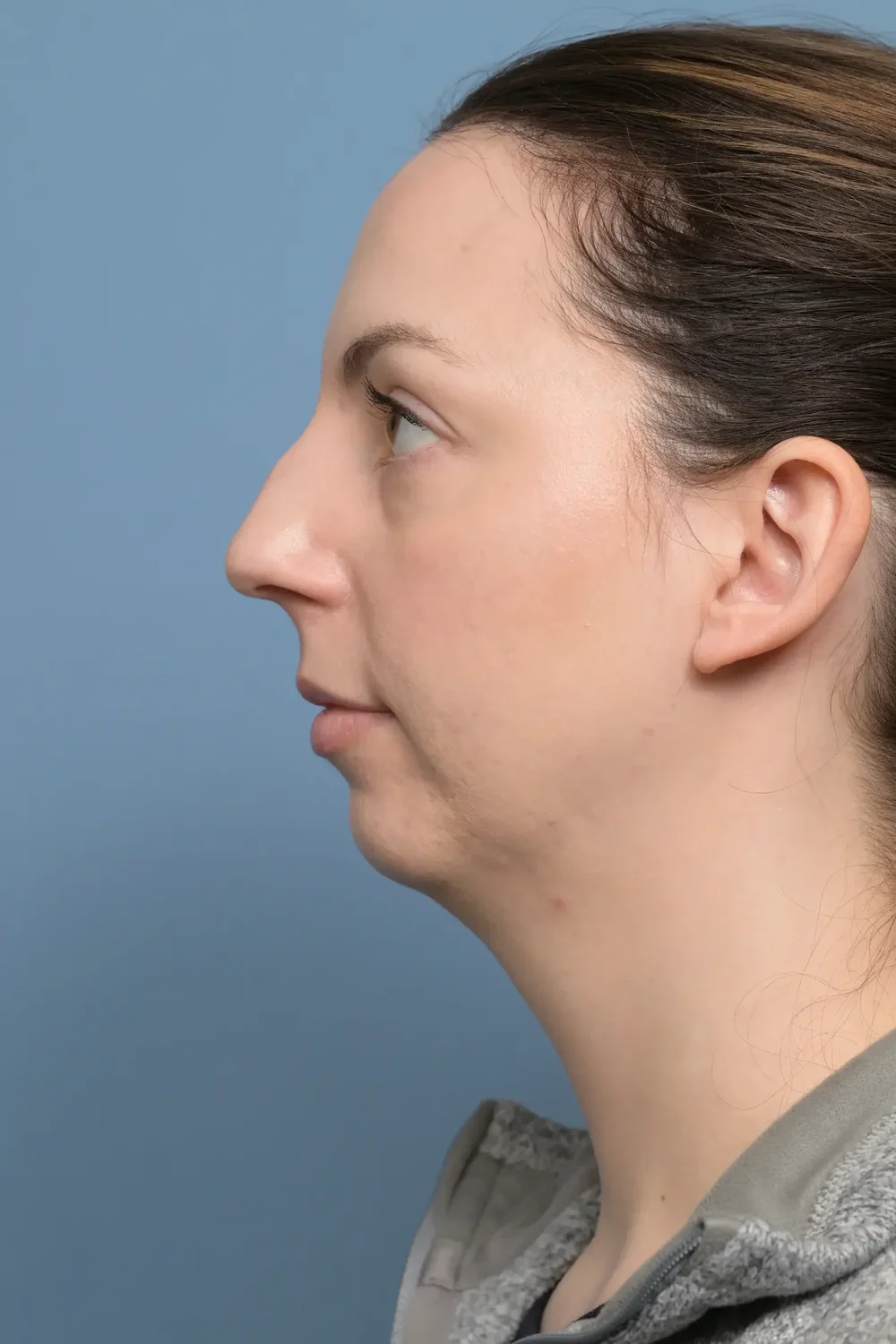 Patient profile before rhinoplasty and chin implant surgery
