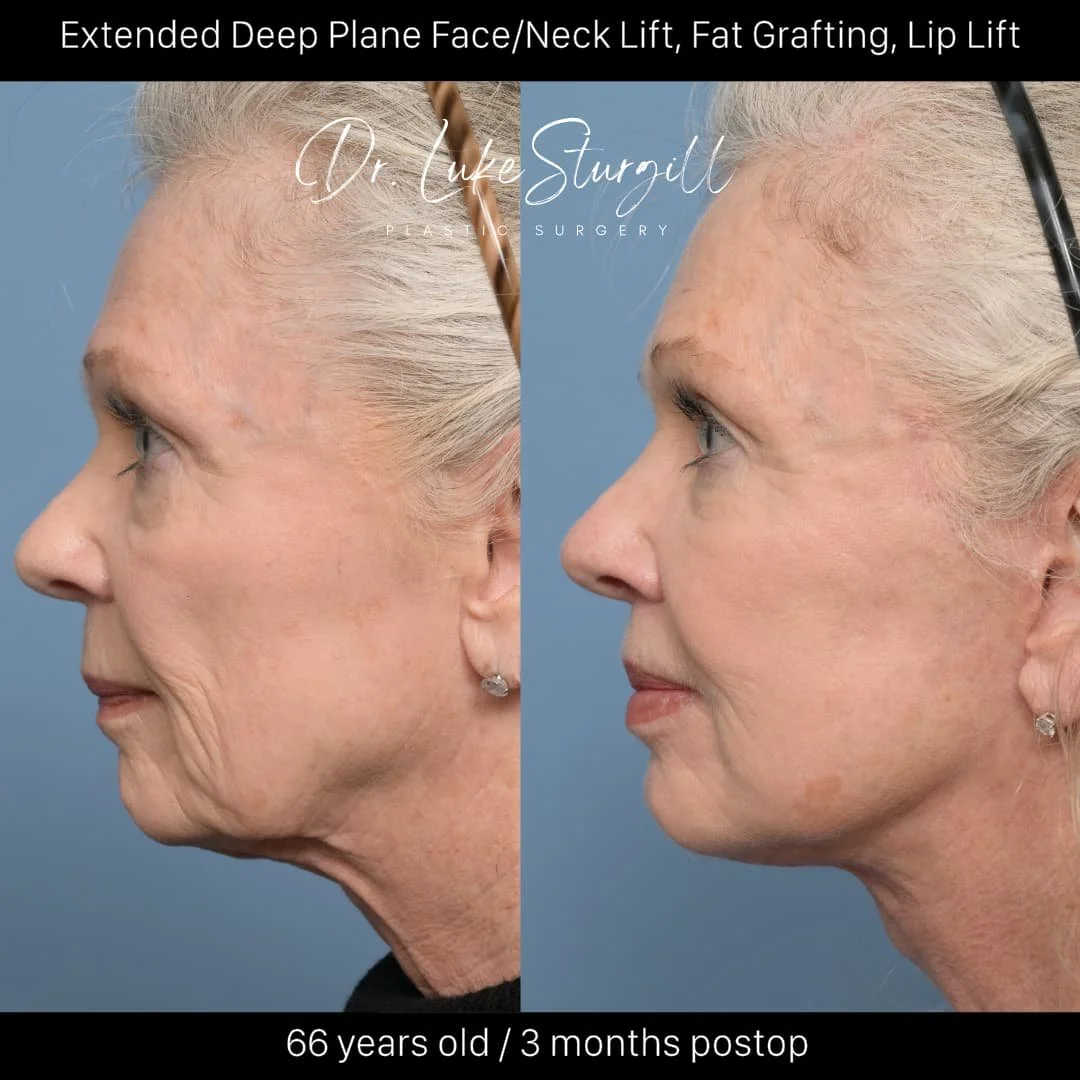 Deep plane facelift before and after — lateral view — female patient