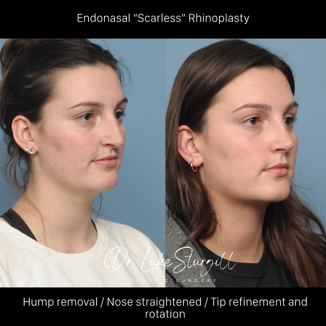 Rhinoplasty before and after — base view — female patient