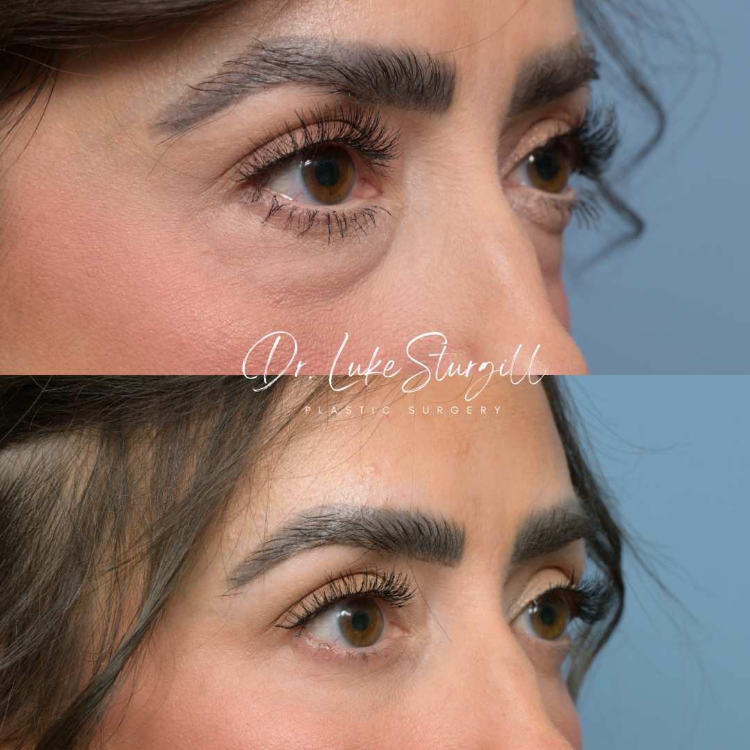 Eyelid surgery before and after — front view — female patient