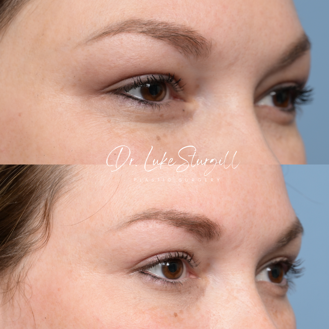 Eyelid surgery before and after — oblique view — female patient