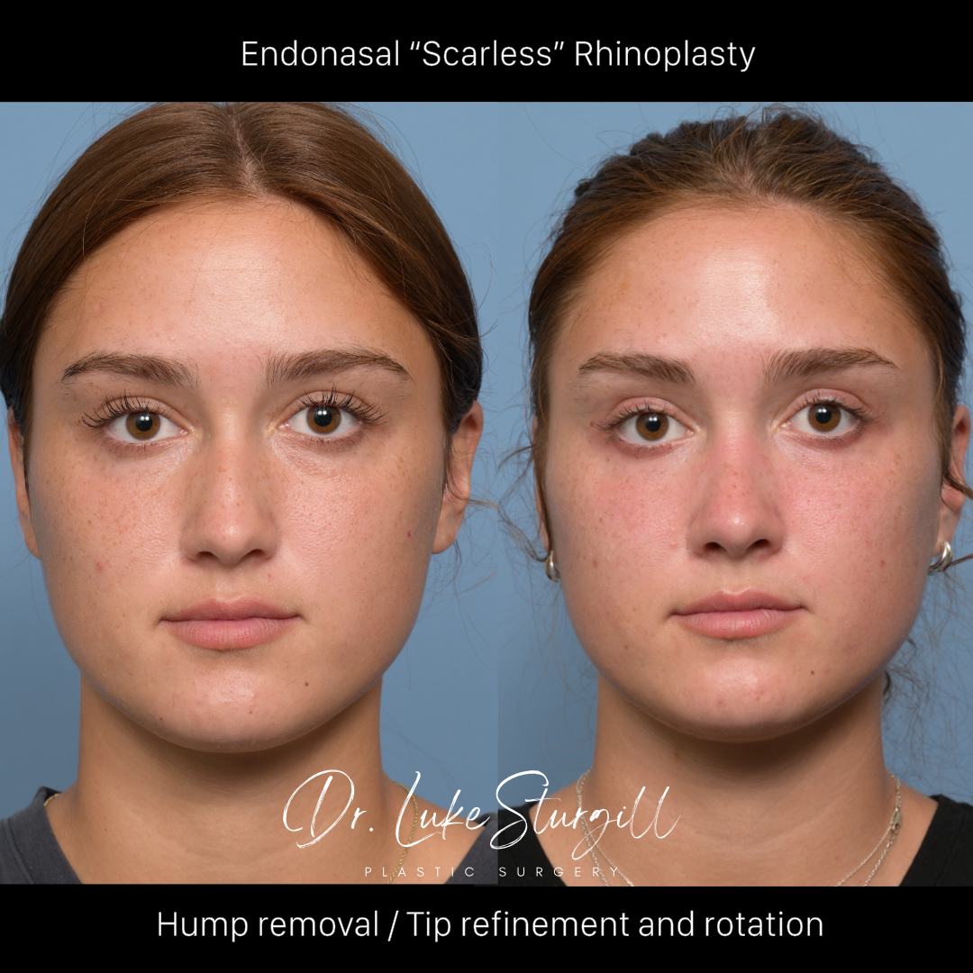 Rhinoplasty before and after — base view — female patient