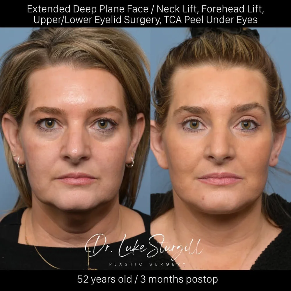 Deep plane facelift before and after — front view — female patient