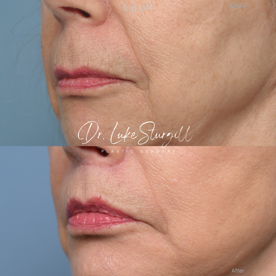 Lip lift before and after — oblique view — female patient