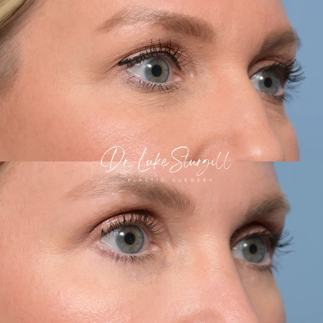 Close-up of a woman's eyes showing before and after cosmetic eyelid surgery, with the logo 'Dr. Luke Sturgill Plastic Surgery' in the center.